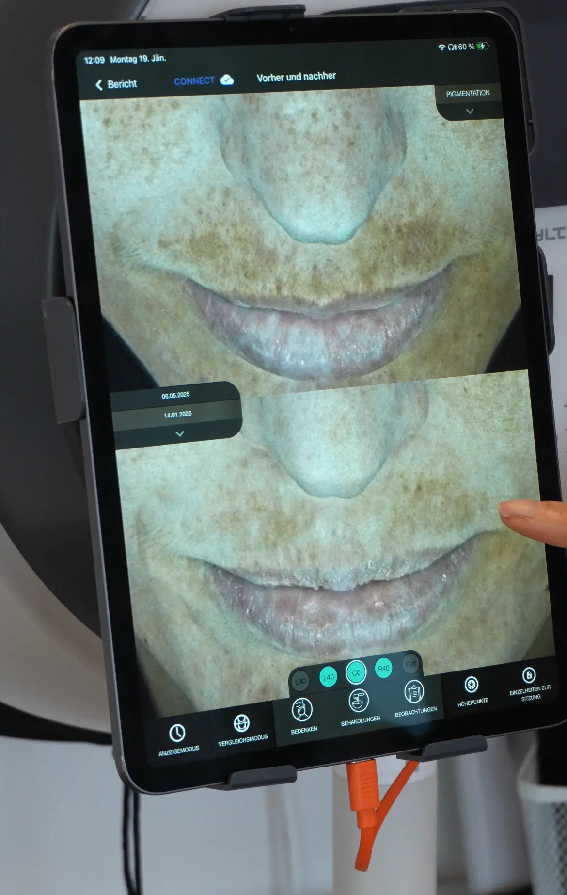 Vorher-Nachher-Vergleich einer Hautanalyse auf dem REVIDERM Observ Tablet